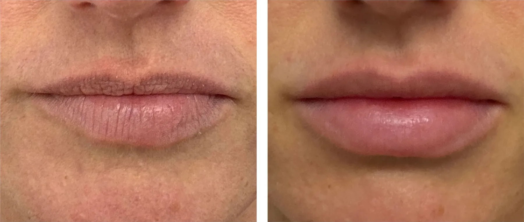 Before and after photos of a patient’s lips, with a fuller, smoother lip shape after lip filler